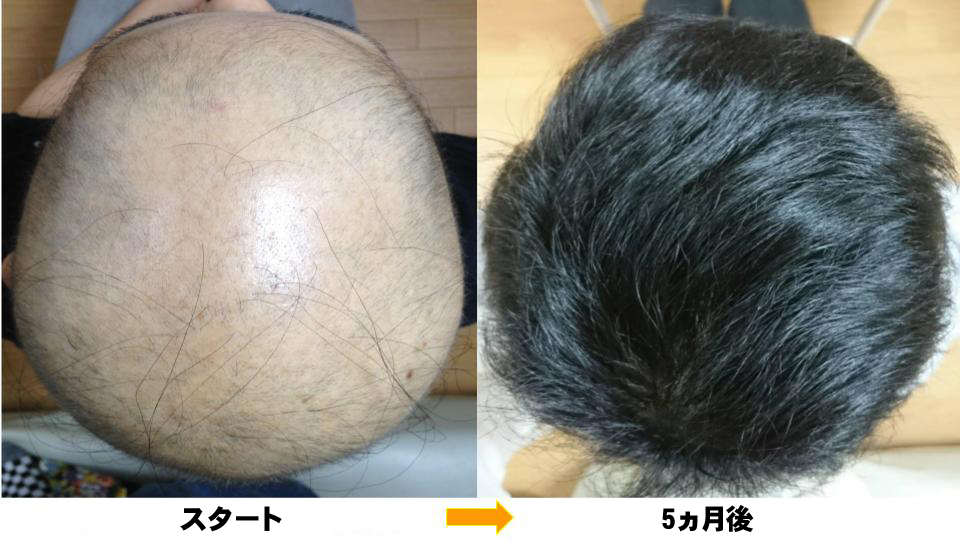 改善が難しい円形脱毛症もお任せ下さい 原因と対策が出来ているからこその結果が 熊本スーパースカルプ