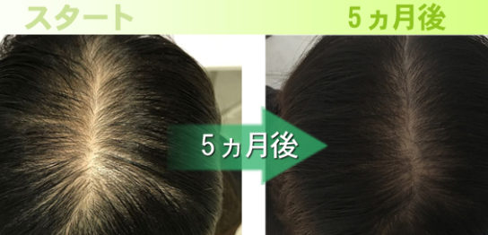 かめきちさんも発毛成功！熊本で薄毛AGA対策・治療は熊本スーパー発毛センターくまなん店！