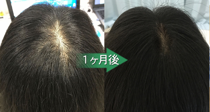 30代女性 薄毛の原因解明と解消が鍵 1か月で発毛に成功されたm様 熊本スーパースカルプ