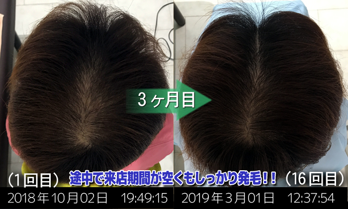 30代男性 薄毛の自己対策では限界な方も しっかり発毛されています 熊本スーパースカルプ