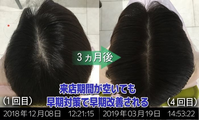 30代女性 産後の抜け毛も早期対策で早期改善 熊本スーパースカルプ