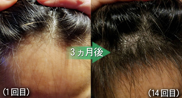 30代女性 急な抜け毛が止まらない 女性が気になる生え際も3ヵ月で改善しています 熊本スーパースカルプ