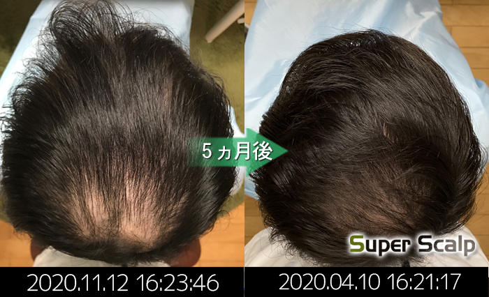 30代男性 家族の為にも薄毛改善を成功させる 熊本スーパースカルプ