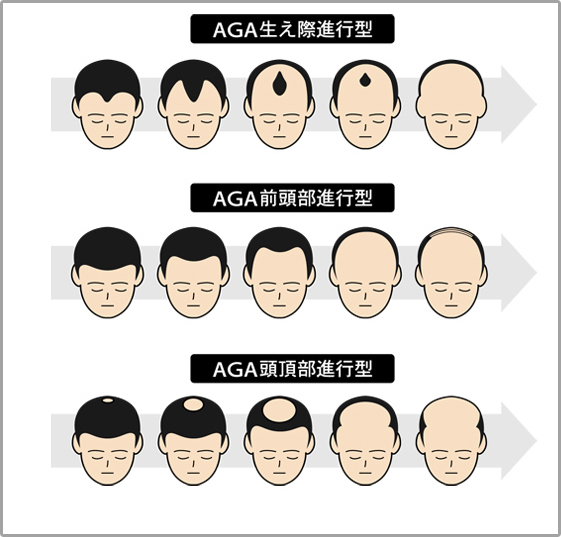 AGAの進行パターン図