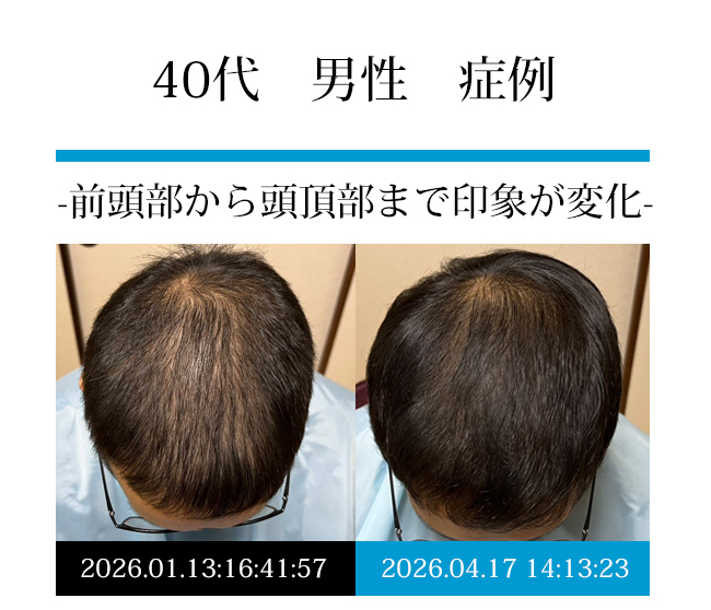 50代男性の発毛症例写真