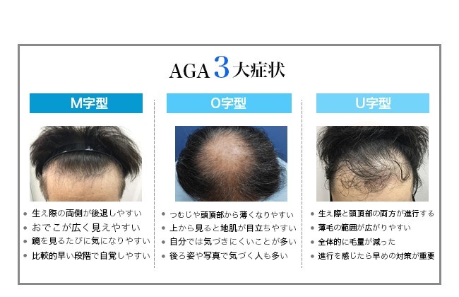 AGA3大症状 M字型・O字型・U字型の比較