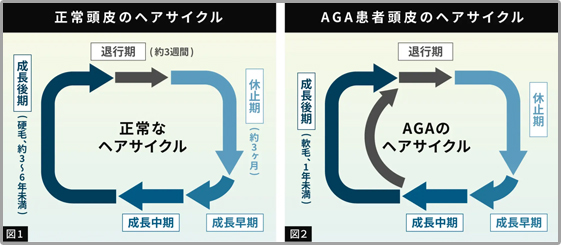 ヘアサイクル比較図（正常vs AGA）