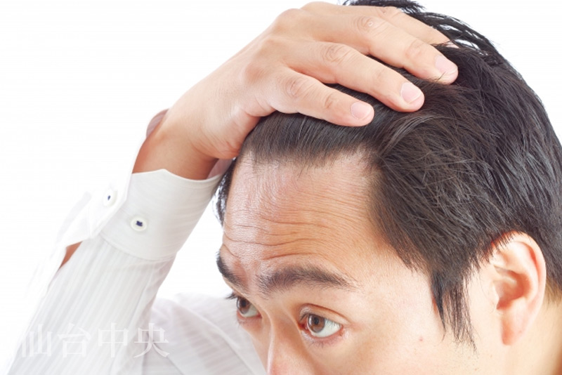 生え際の後退イメージ