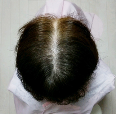 施術後の頭皮の様子