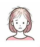 びまん性脱毛症