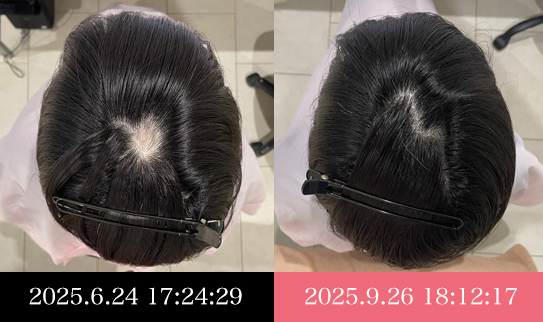 30代女性の発毛症例 ビフォーアフター