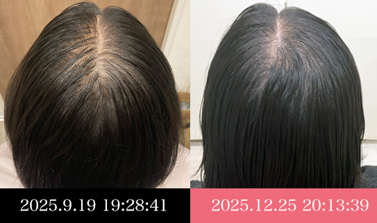 30代女性の発毛症例 ビフォーアフター
