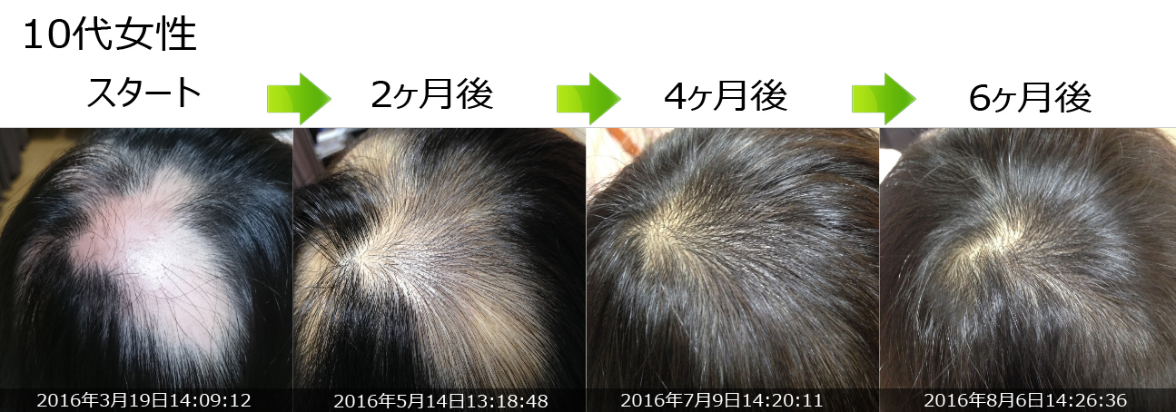 10代女性　円形脱毛症治療の改善例