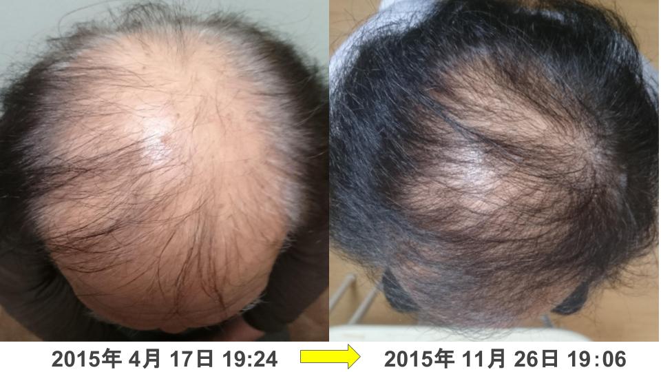 70代男性AGA治療(頭頂部)改善例②
