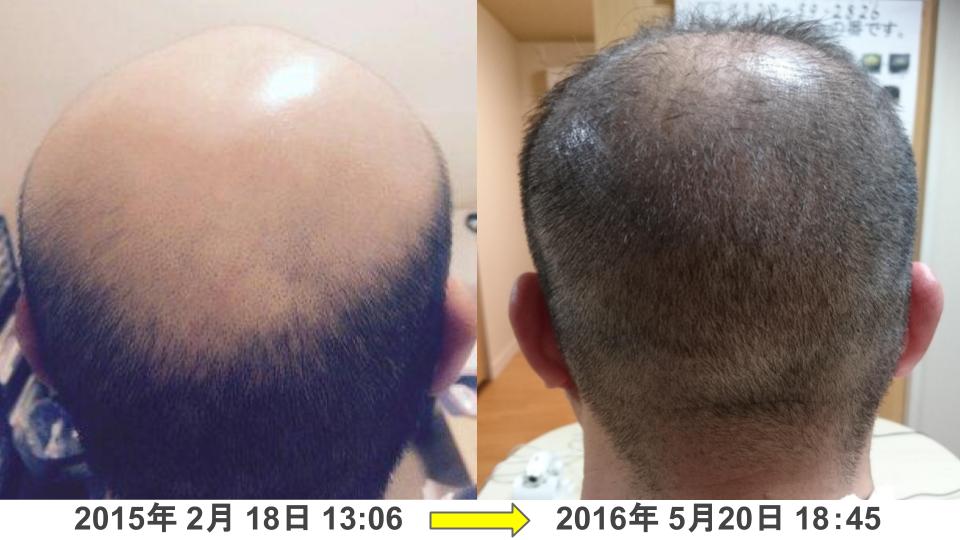 40代男性円形脱毛症治療発毛実績