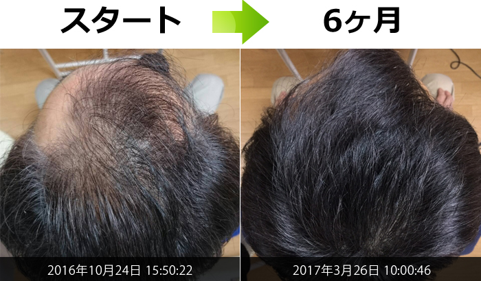 50代男性ＡＧＡ治療(頭頂部)発毛症例