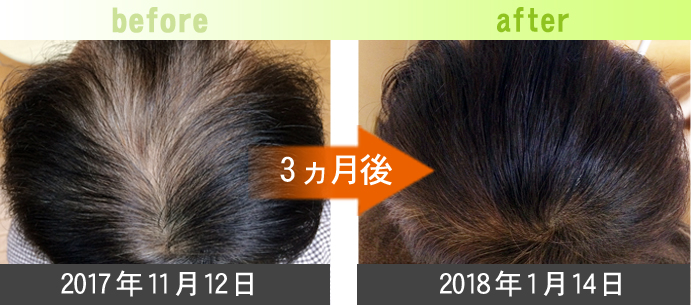 50代男性AGA治療(頭頂部)発毛症例