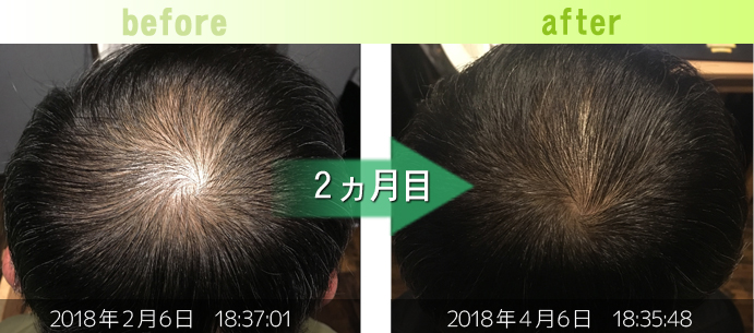 50代男性ＡＧＡ治療(つむじ周り)発毛改善例