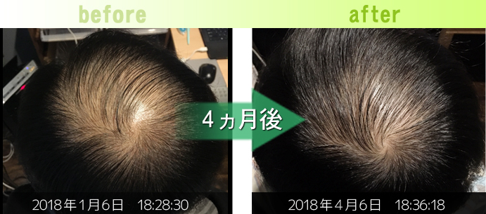 30男性つむじ周りAGA治療発毛経過