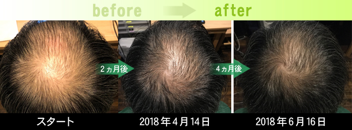 40代男性つむじ周り発毛経過