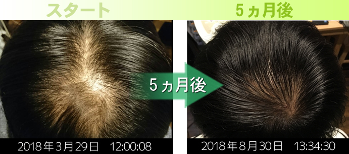 40代男性つむじ周りの発毛実績