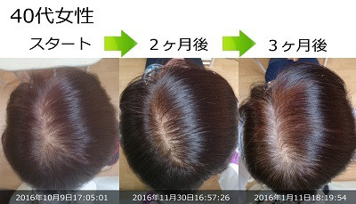 FAGA治療改善例写真