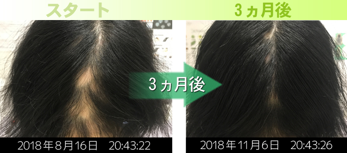 40代女性の円形脱毛症治療改善実績写真