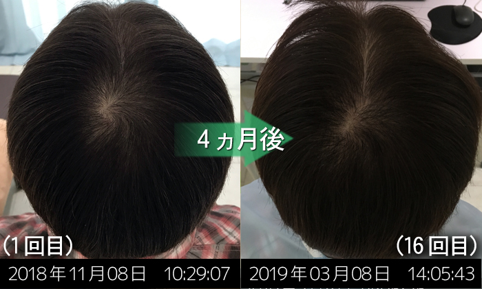 AGA治療